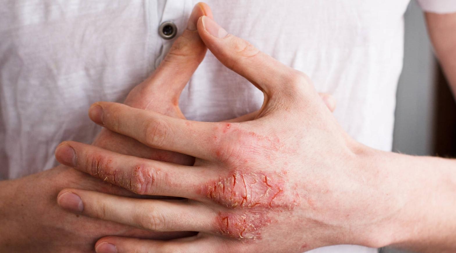 Comment prévenir l’eczéma nerveux ? (Médecin)